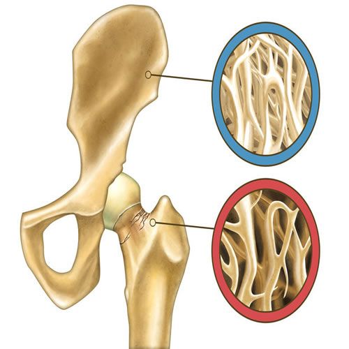 Kemik Erimesi - Osteoporoz